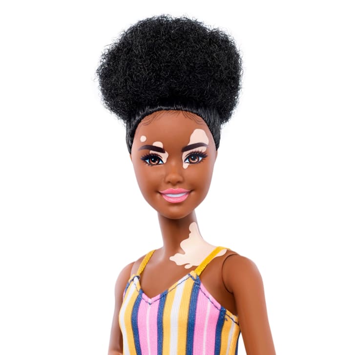 vitiglios barbie